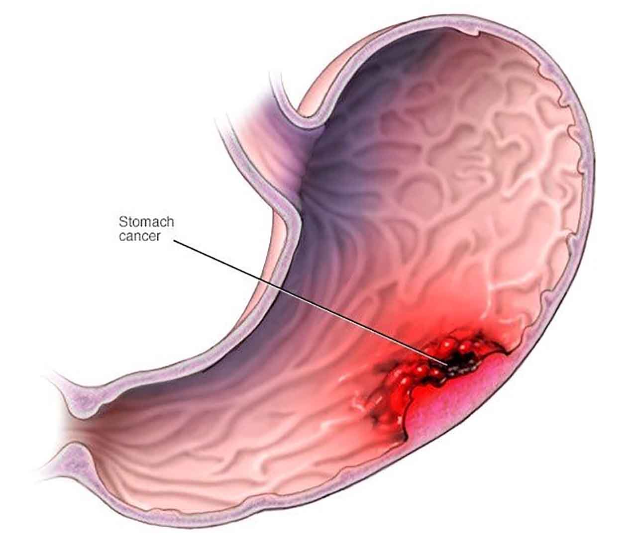 Cancer Of The Stomach Kills: Stop Taking Too Much Of These threeThings If You Want To Live Long