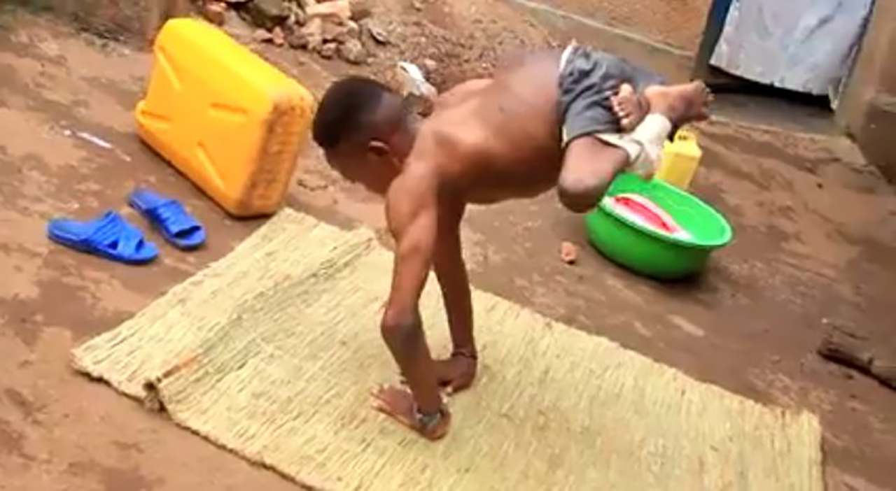 Meet a young man born with half a body, a rare condition most people do not understand