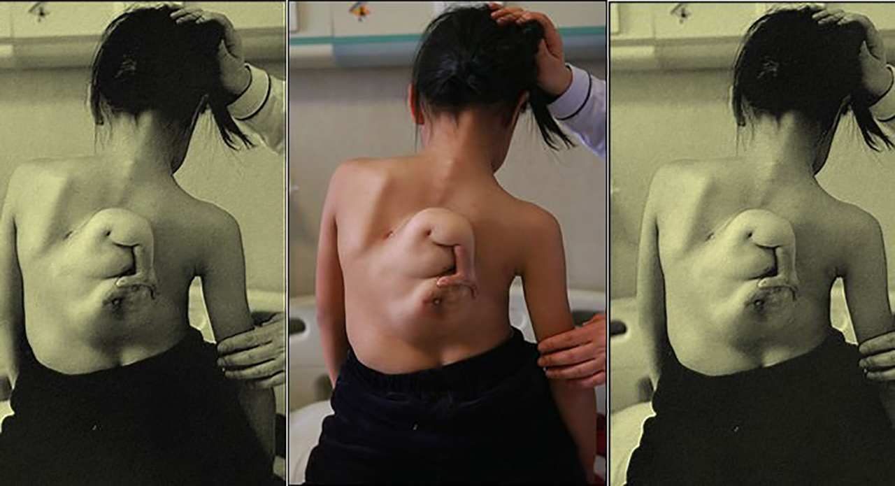 See People Who Had Extra Body Parts. Thank God For Modern Medicine