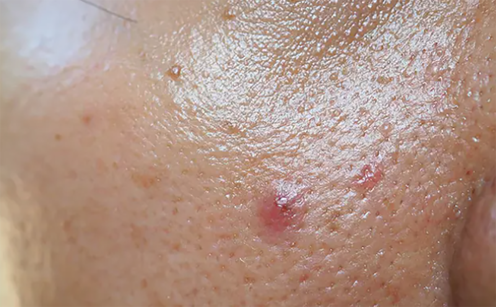 Best essential oils to treat oily SKIN